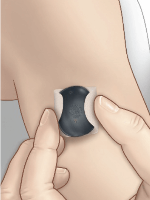 En hand f&auml;ster en liten, svart medicinsk CGM-s&auml;ndare p&aring; en &ouml;verarm i en klinisk milj&ouml;.