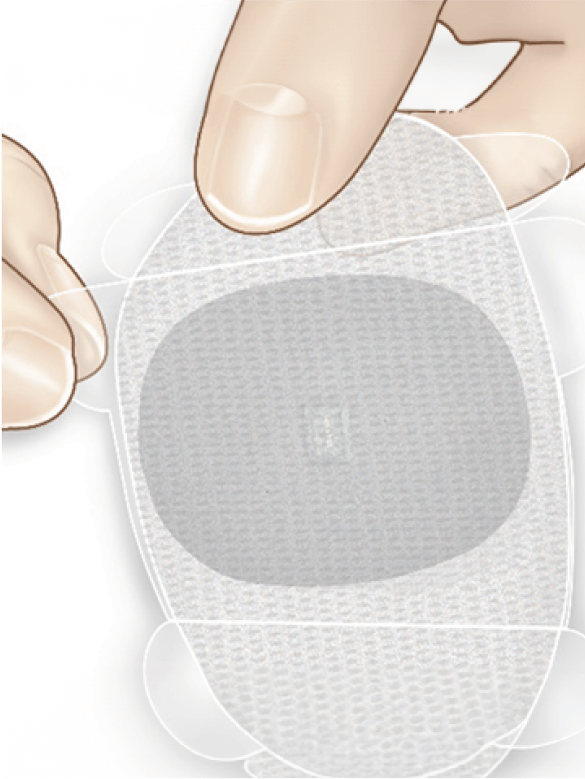 En hand applicerar ett runt sj&auml;lvh&auml;ftande pl&aring;ster med en CGM-sensor i mitten, mot en vit bakgrund.